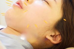 優しい鍼による産後ママへの美容鍼 出張鍼灸整体院CASHÉLでの目黒区の産後ママへの美容鍼